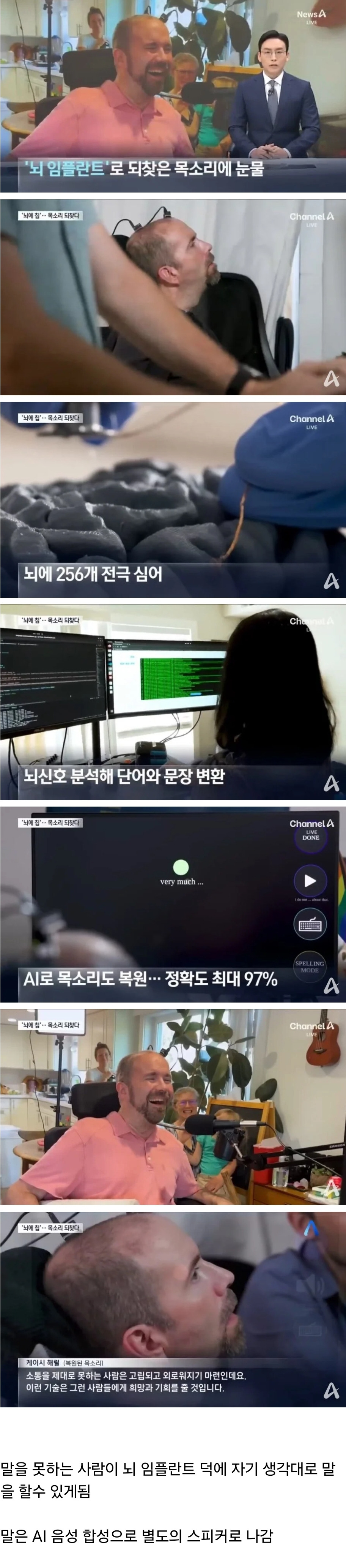 뇌 임플란트 수술 근황