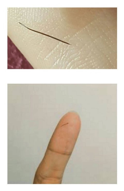 쌩뚱맞은 부위에 생기는 털