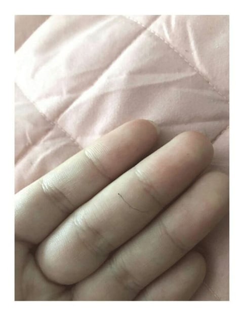 쌩뚱맞은 부위에 생기는 털