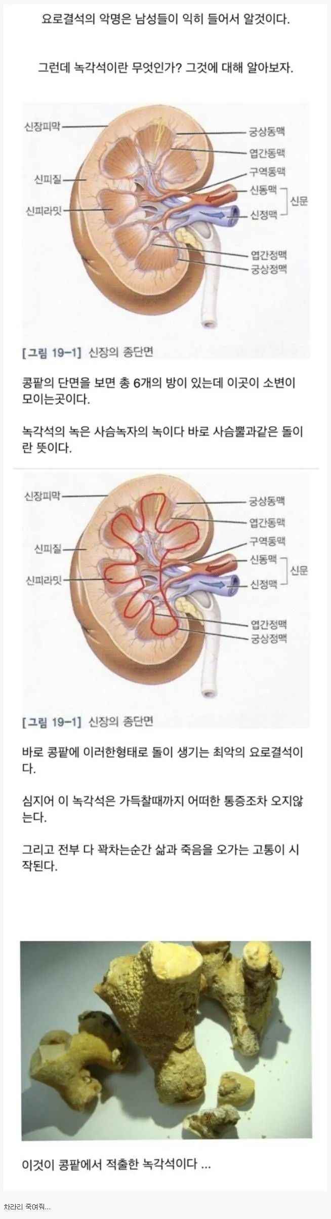 최악의 요로결석.