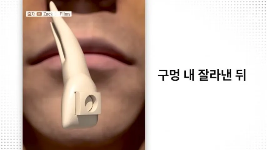 눈에 치아를 넣어 시력을 회복하는 수술