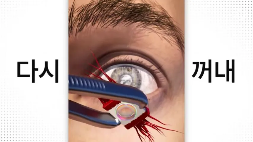 눈에 치아를 넣어 시력을 회복하는 수술