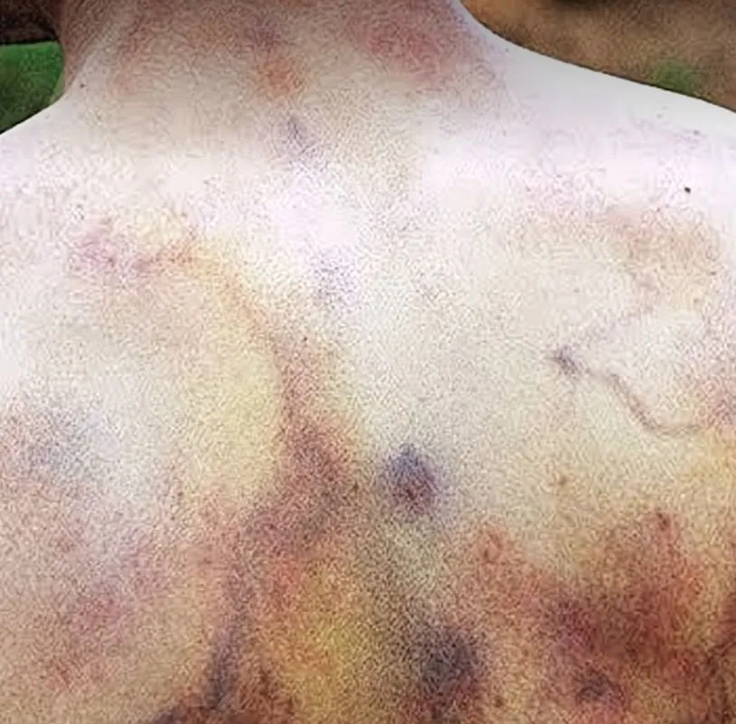 번개 맞은후 피부 변화