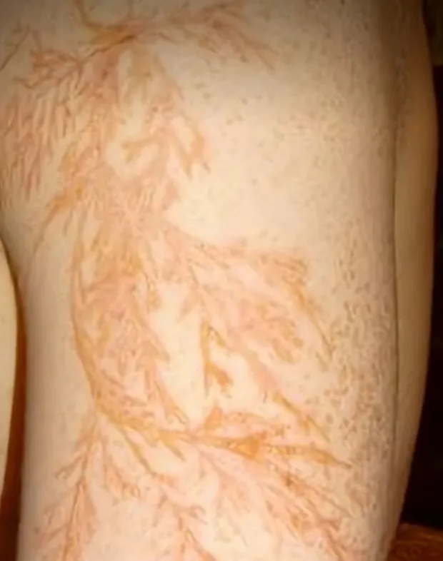 번개 맞은후 피부 변화