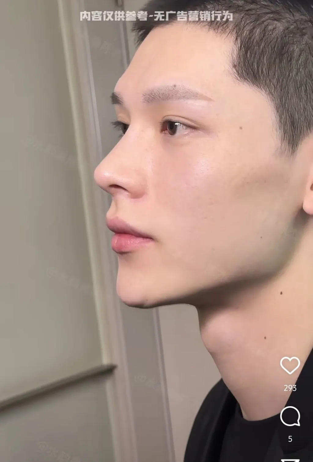 남자 코수술 레전드.jpg