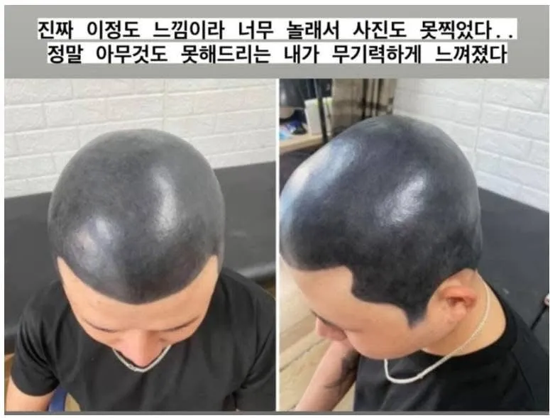 다른데서 망해온 문신 손도 못대고 병원에 보낸 문신사