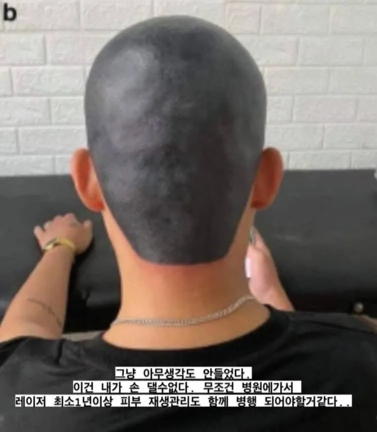 다른데서 망해온 문신 손도 못대고 병원에 보낸 문신사