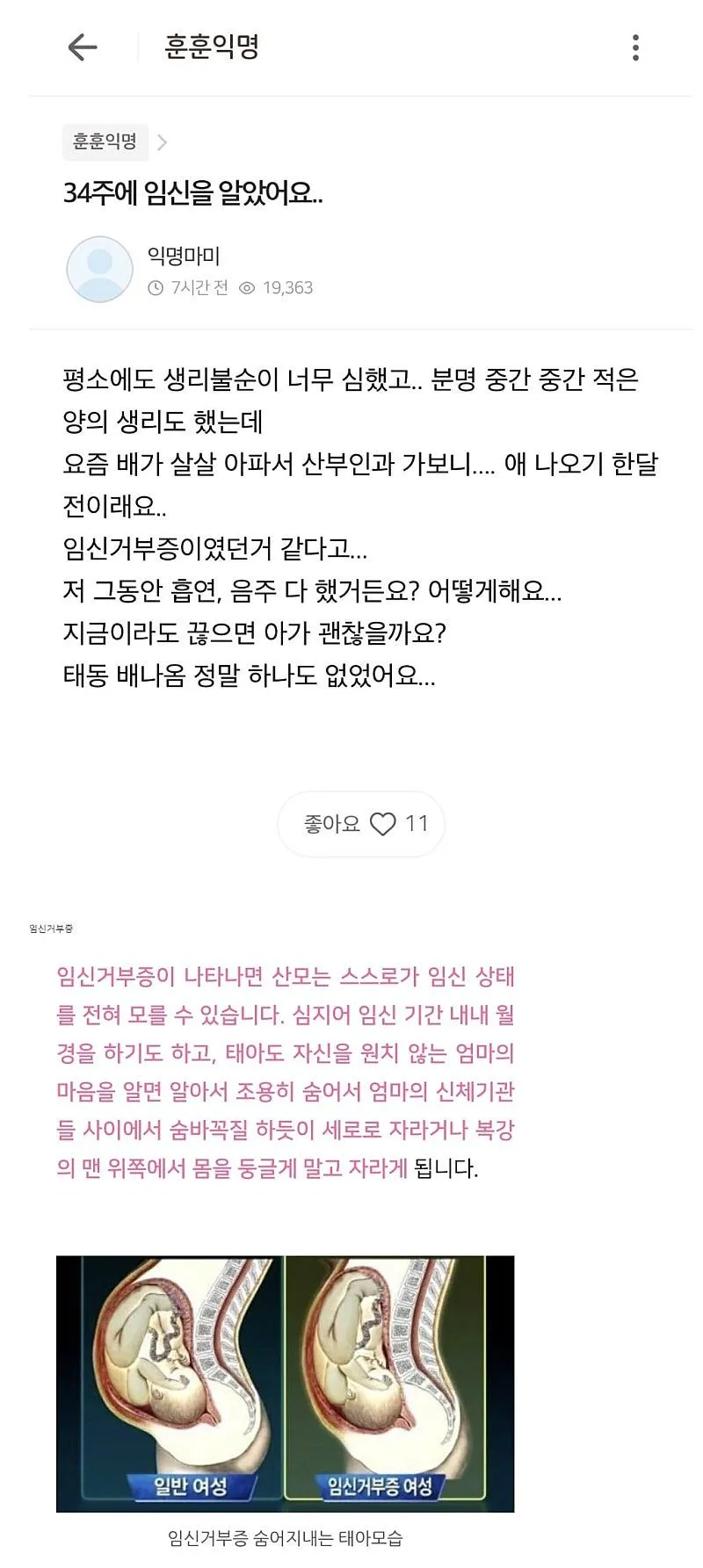 34주만에 임신을알게된 임산부