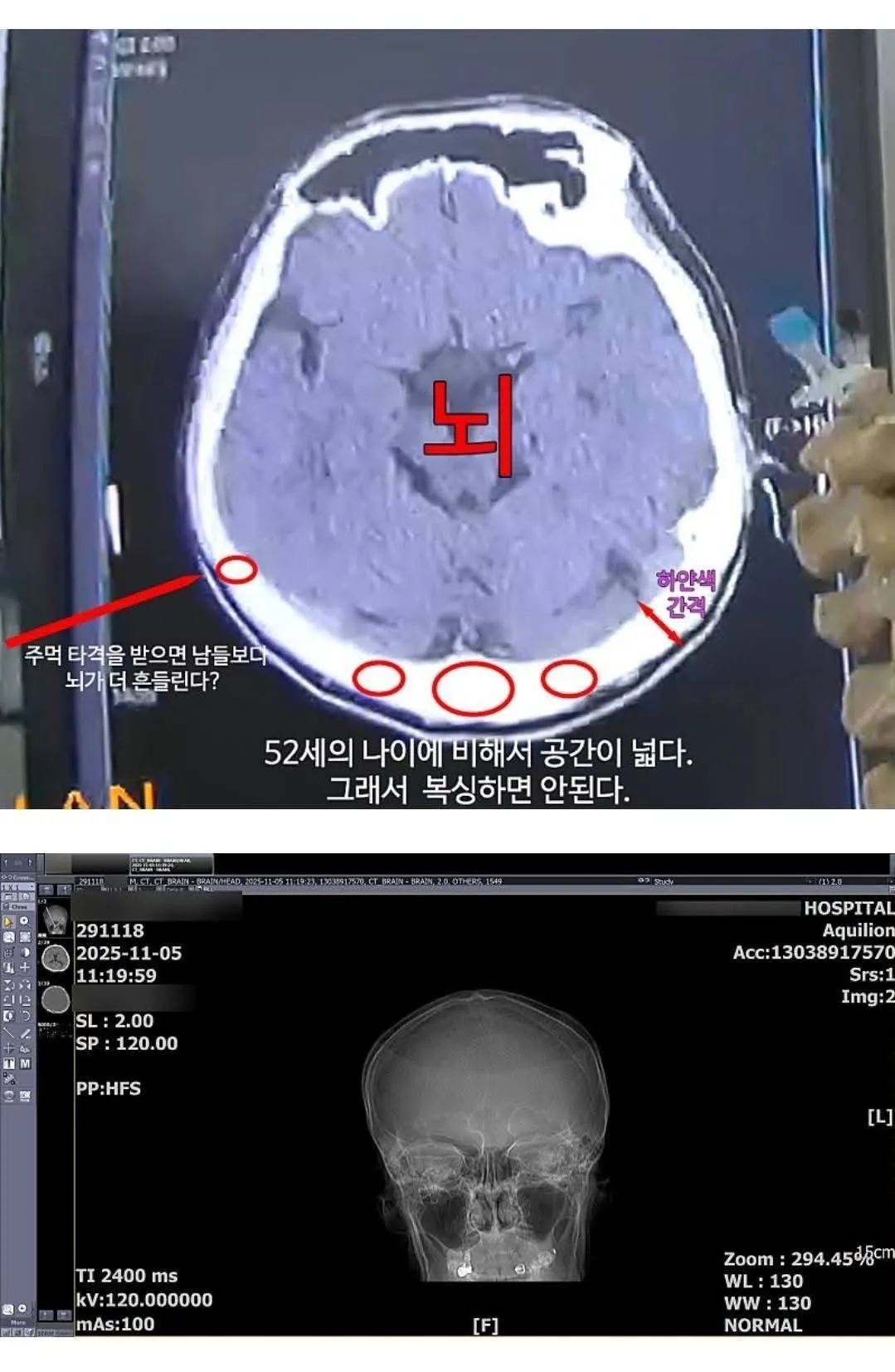 복싱 하지 말라는데 의사 말이 틀린 거 같다며 하겠다는 52살