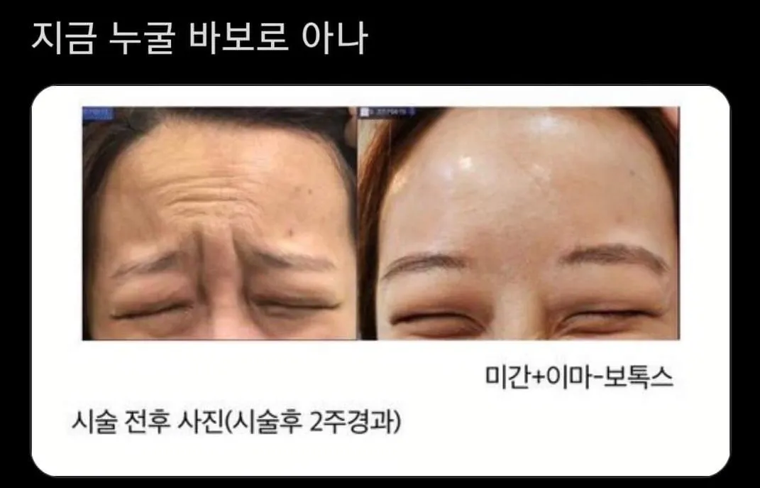 효과 확실한 보톡스 시술 전 후 사진 ㄷㄷㄷ...JPG