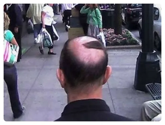 대머리를 가리는법!