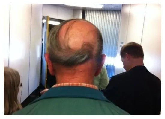 대머리를 가리는법!