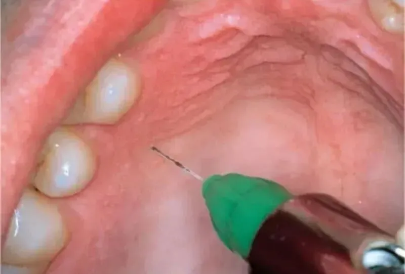 치과에서 가장 아픈 마취