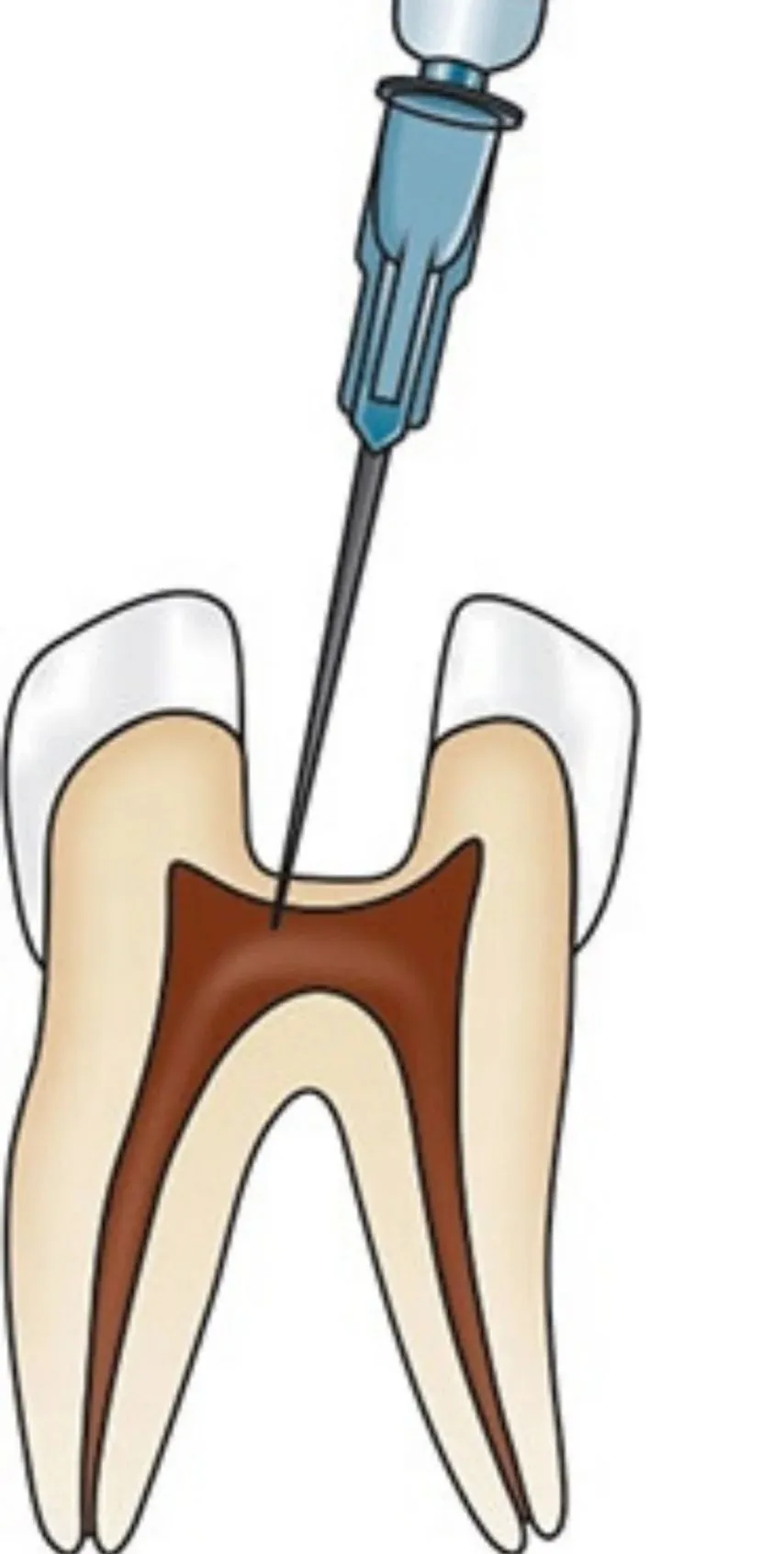 치과에서 가장 아픈 마취