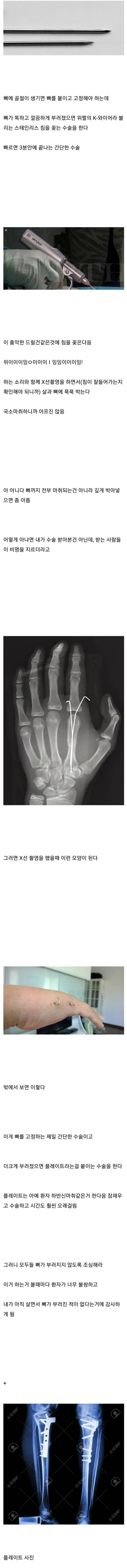뼈 안 부러져본 사람들이 의외로 모르는 사실