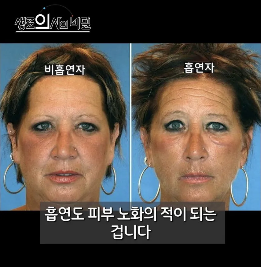 흡연이 피부에 미치는 영향.jpg