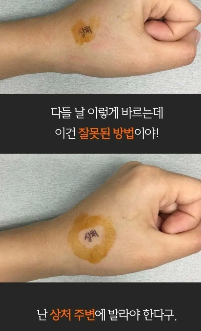 빨간약은 상처에 직접 발라 주세요